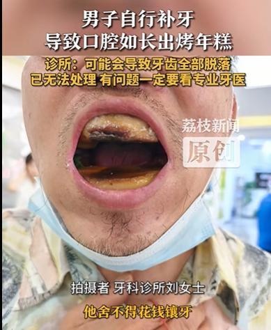 非凡策略 男子买5元树脂自行补牙，口腔如长出“烤年糕”，诊所回应：可能会导致牙齿全部脱落